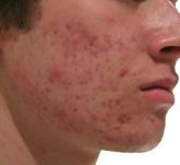 Tratamentos  Naturais - Doenças Da Pele-ACNE